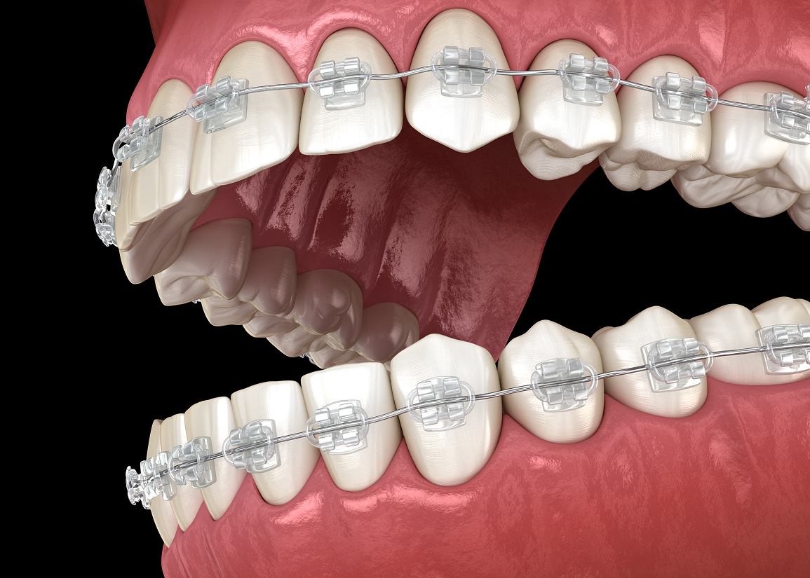 Clear Braces at Clark St Dental of Lakewood