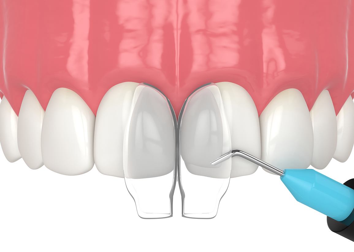 Dental Bonding at Clark St Dental of Lakewood
