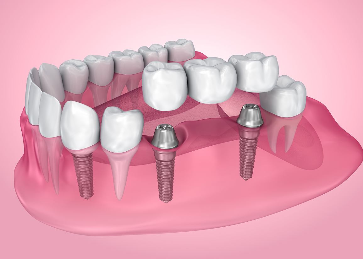 Dental Bridges at Clark St Dental of Lakewood