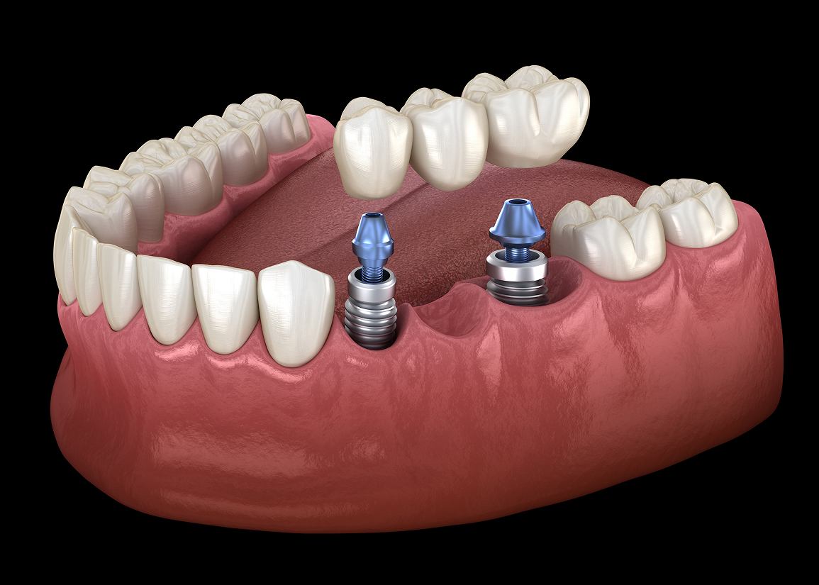 Dental Bridges at Clark St Dental of Lakewood
