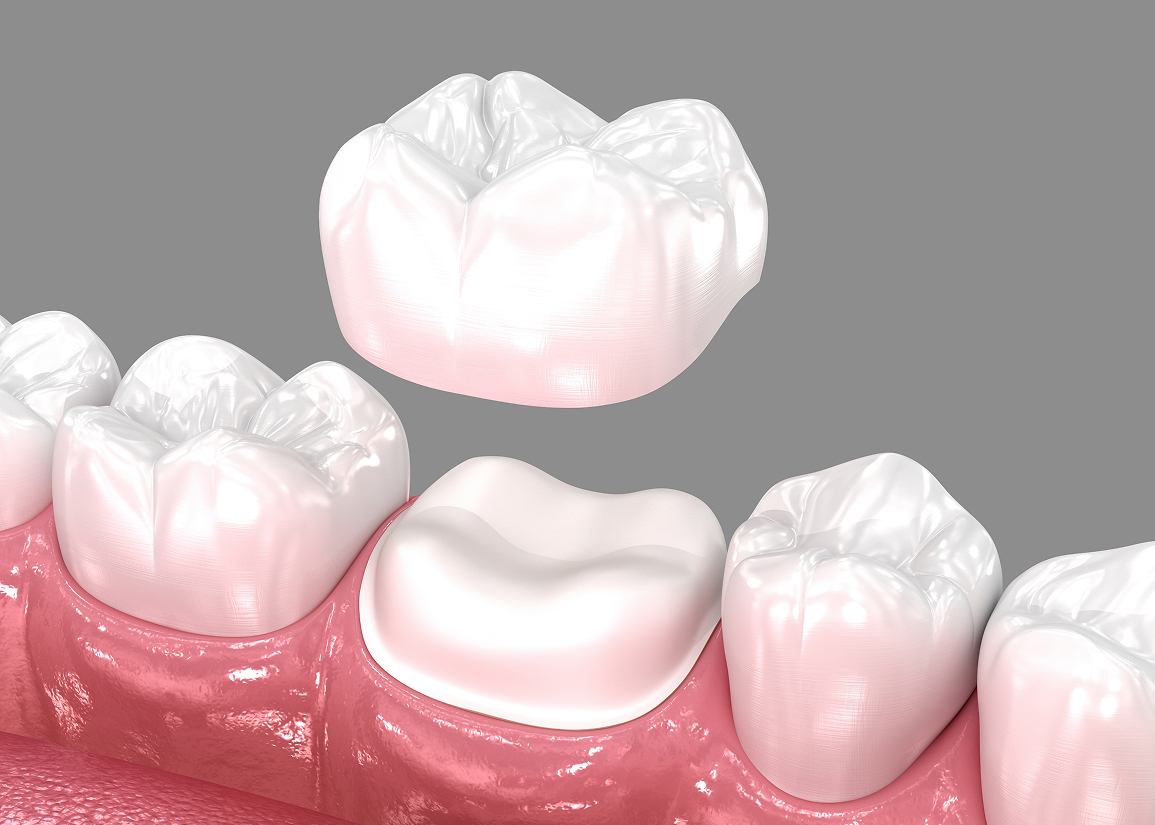 Dental Crowns at Clark St Dental of Lakewood