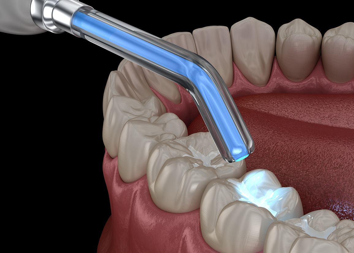 Dental Fillings at Clark St Dental of Lakewood