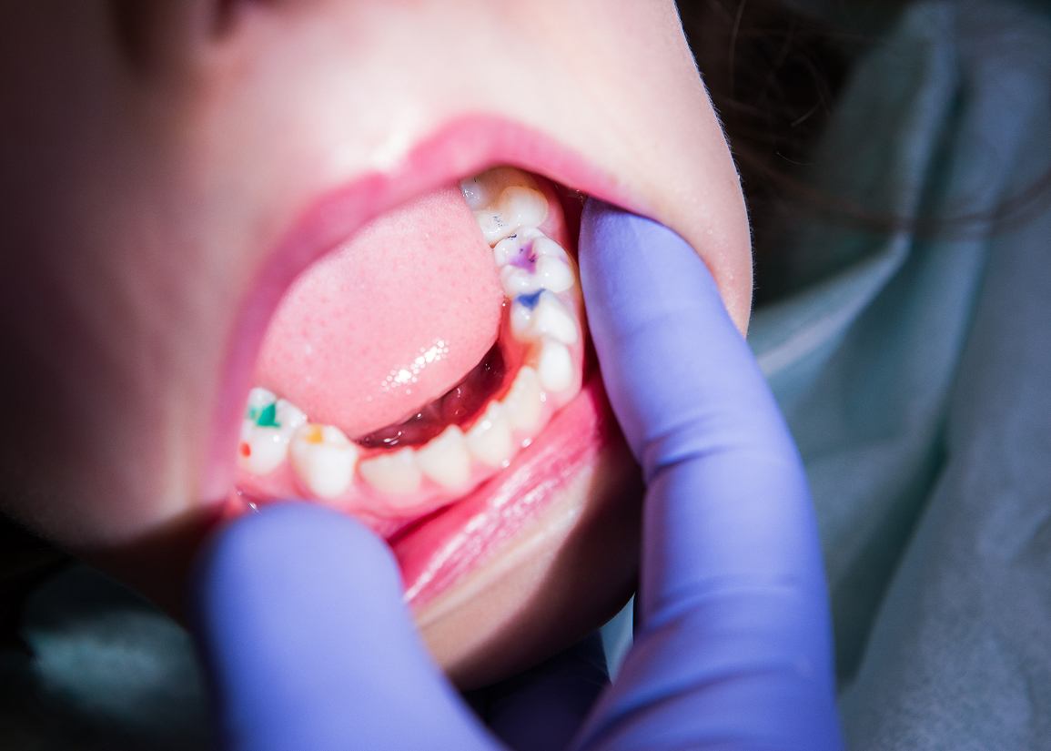 Dental Fillings at Clark St Dental of Lakewood