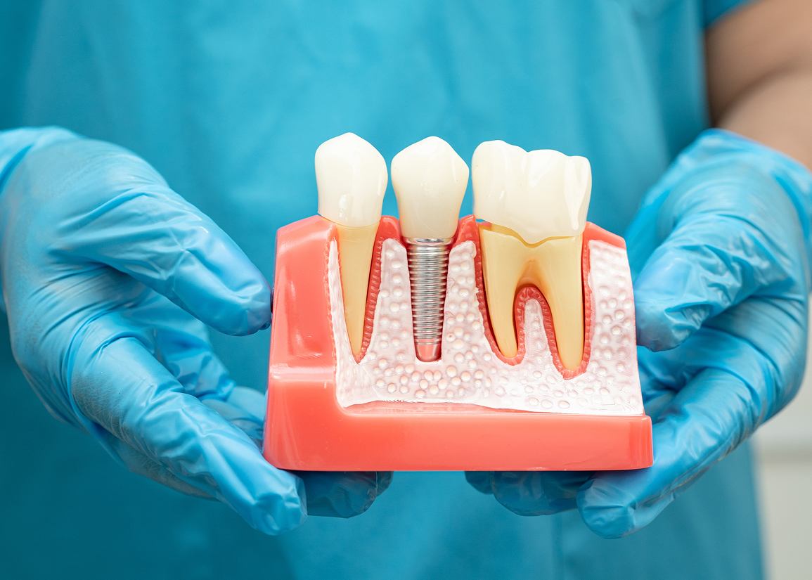 Dental Implants at Clark St Dental of Lakewood