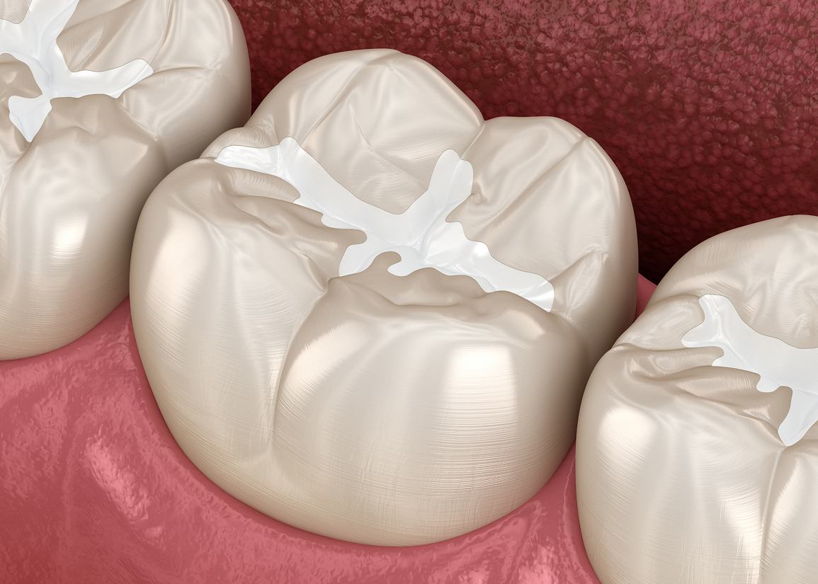 Dental Sealants at Clark St Dental of Lakewood
