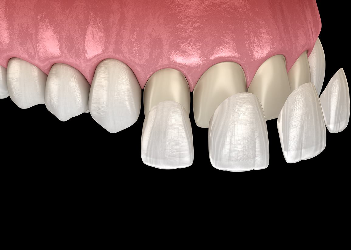 Dental Veneers at Clark St Dental of Lakewood