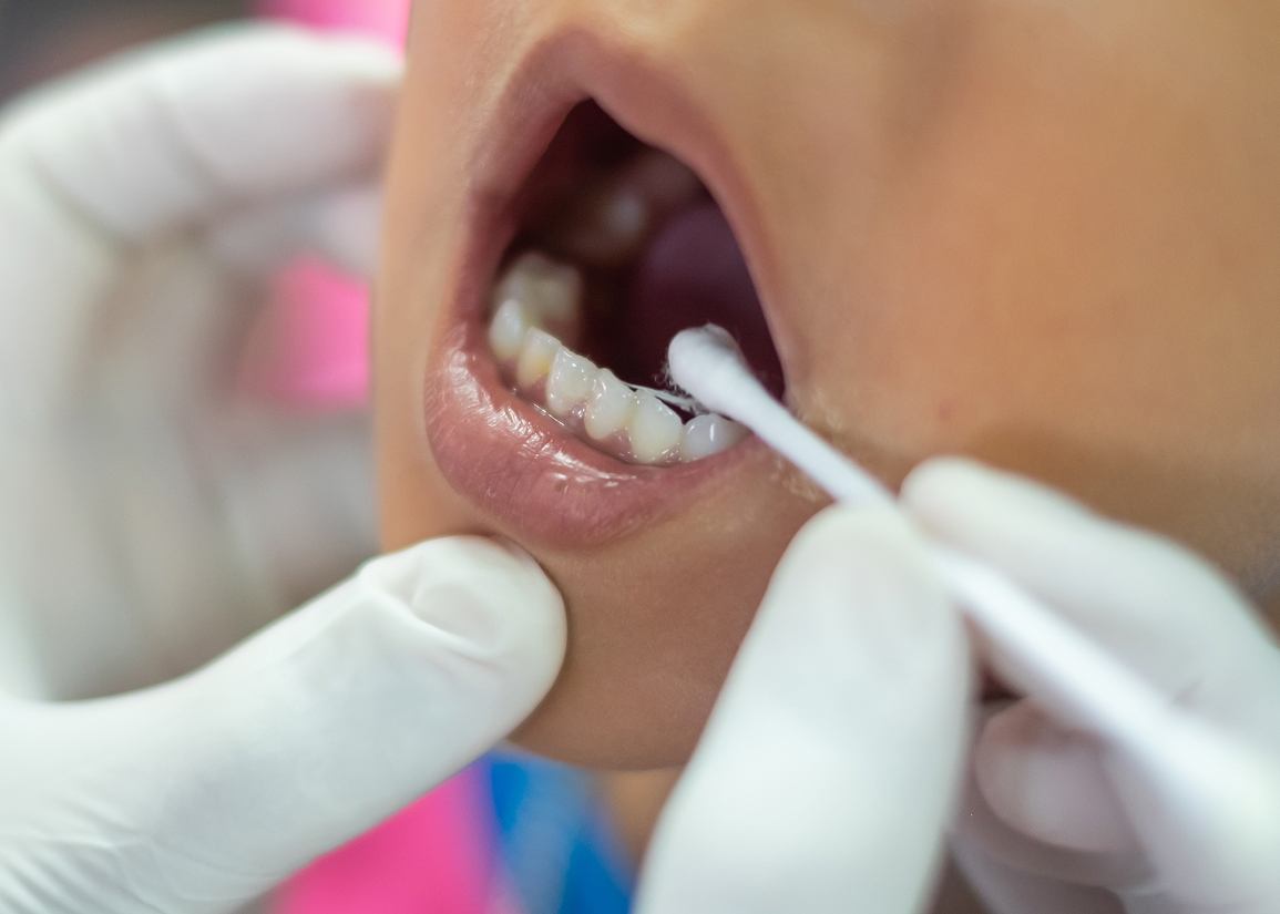 Fluoride Treatment at Clark St Dental of Lakewood