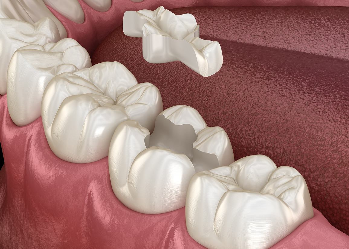 Onlays & Inlays at Clark St Dental of Lakewood
