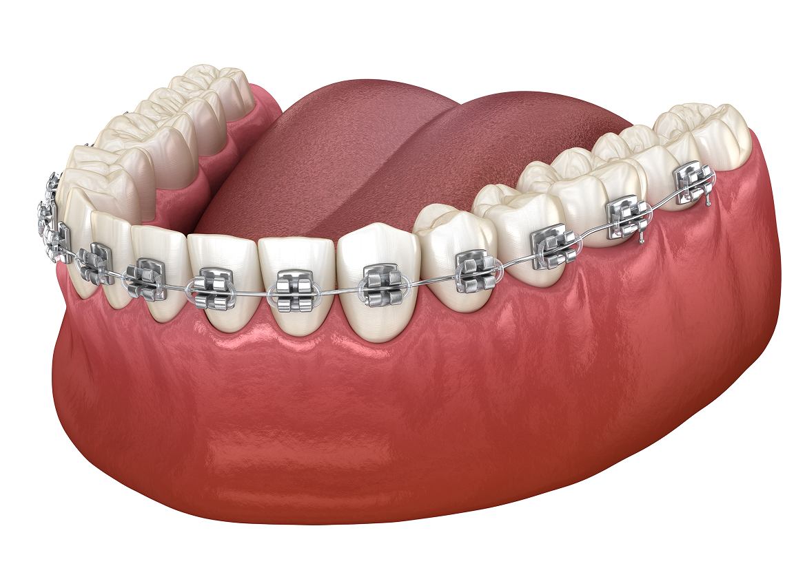 Metal Braces at Clark St Dental of Lakewood
