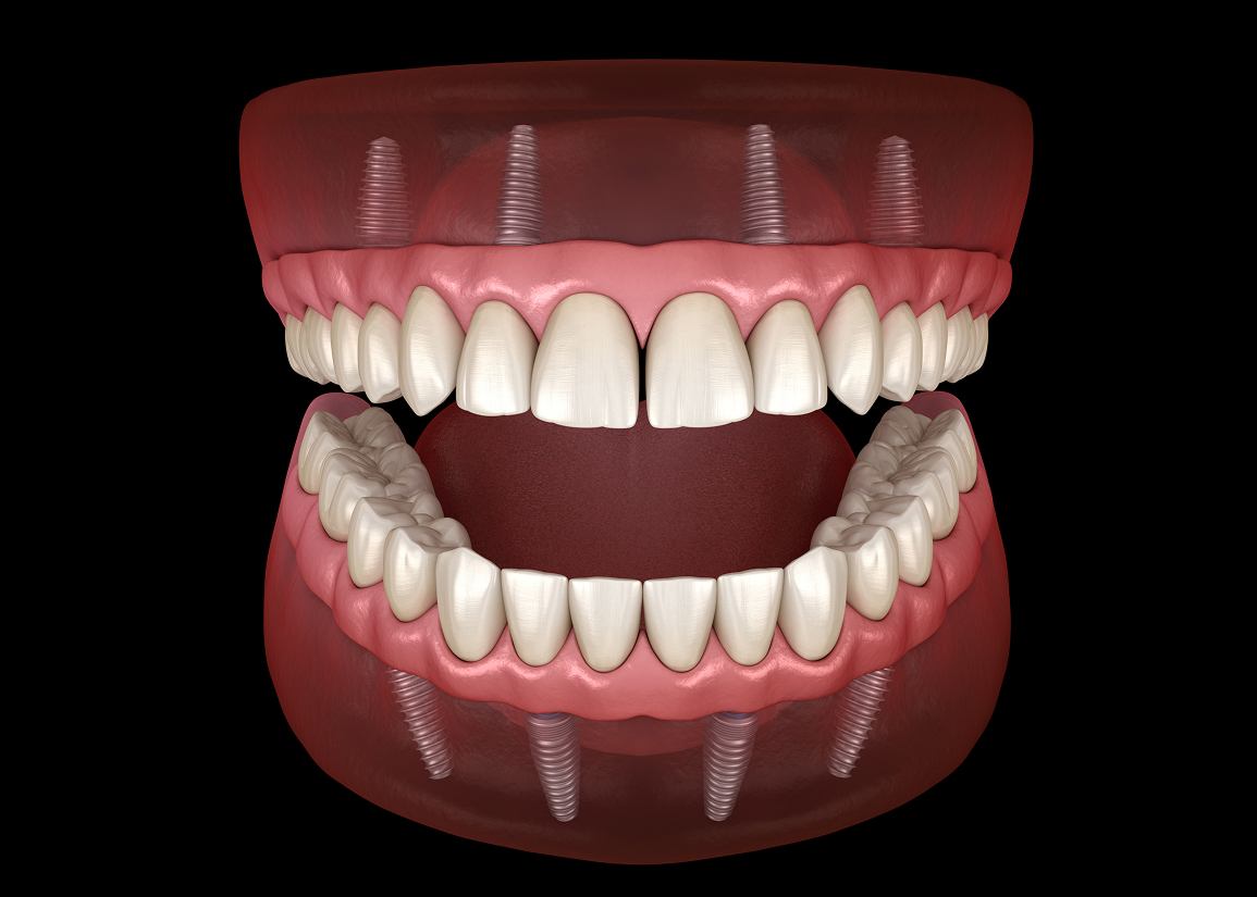 Complete & Partial Dentures at Clark St Dental of Lakewood