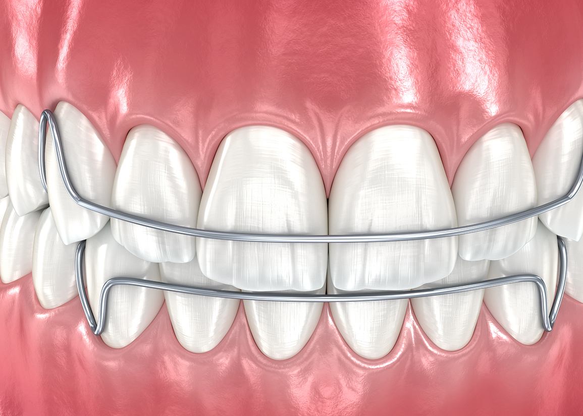 Retainers at Clark St Dental of Lakewood